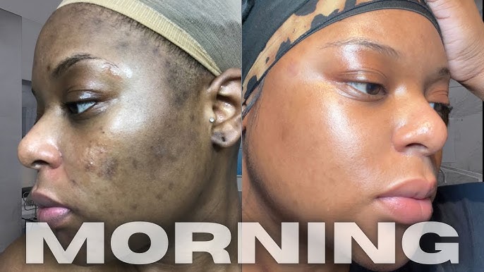 "I started using the Sadoer Collagen serum and cream together to deal with my uneven skin tone and dryness. After just two weeks, the transformation is real—my face feels so much firmer and the 'glow' is actually natural, not just greasy. It’s perfect for my skin type because it doesn't leave that white cast or feel heavy. My dark spots are finally fading and my skin just looks flawless and healthy now!" — Beauty Enthusiast